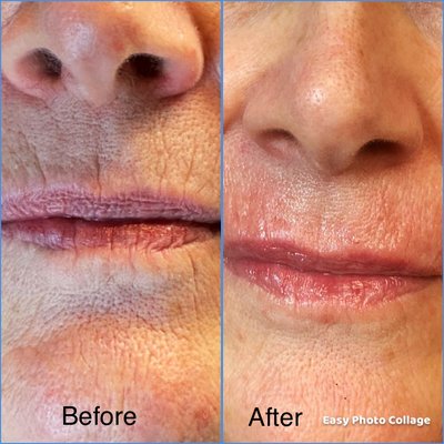 Lip & wrinkles filler