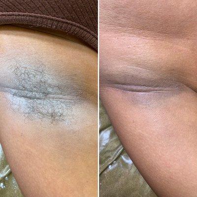 Underarm Wax Before & After