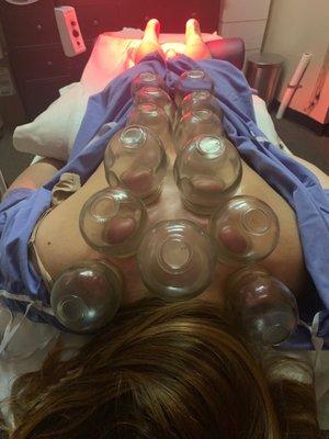 Cupping Therapy