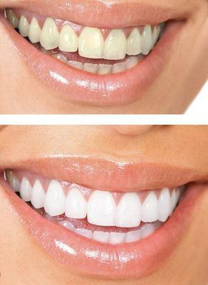 Teeth Whitening