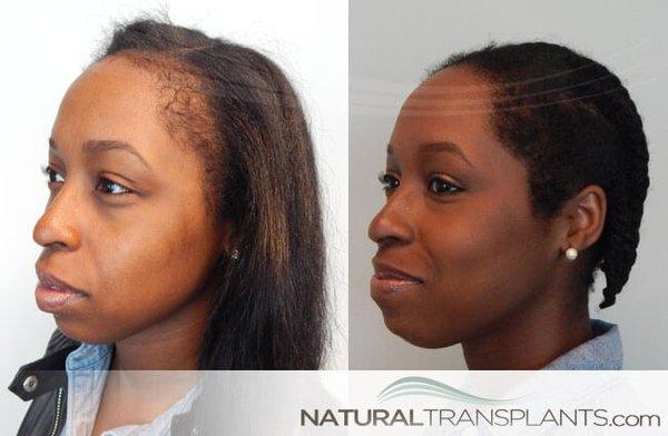 Natural Alopecia Hair Loss Treatment