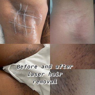 Laser hair removal 1 session