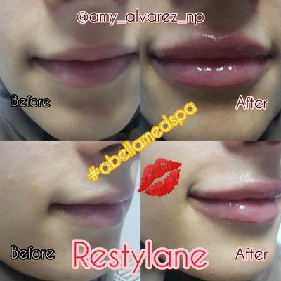 Lips augmentation