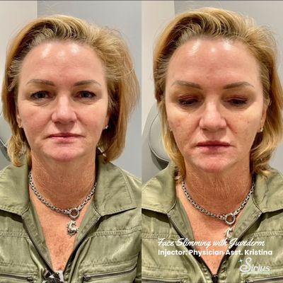 Before & After with Juvederm!