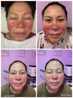 Rosacea after 3 sessions