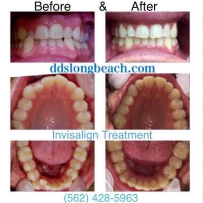 Call us today for a free Invisalign consultation at (562)428-5963