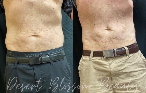 Results immediately after second session of Non-Invasive Laser Lipo