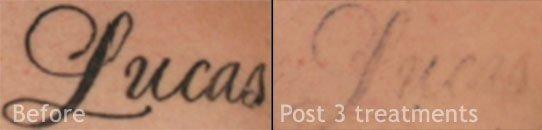 Laser Tattoo Removal NYC - Before & After