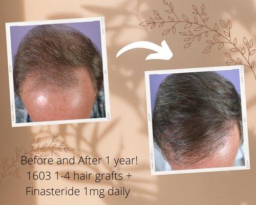 Before and after hair transplantation (FUT) with Dr. Nicole Rogers