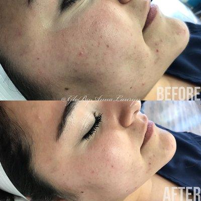 Dermaplaning Facial. Before and After.