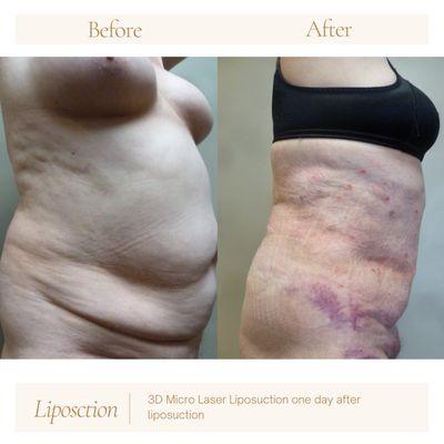 Liposuction one day after the surgery quick recovery