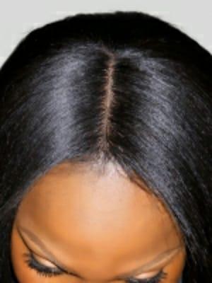 Closure technique