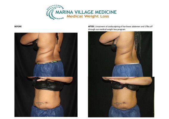 Coolsculpting Before and After in Alameda, CA