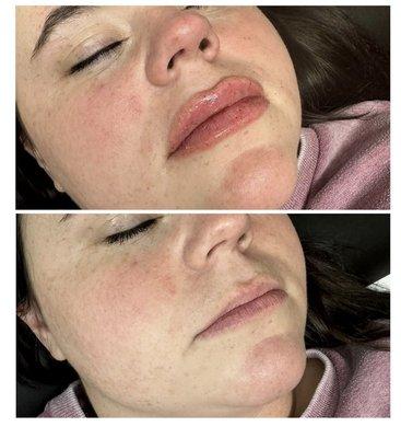 Lip filler. Before on bottom, after on top.