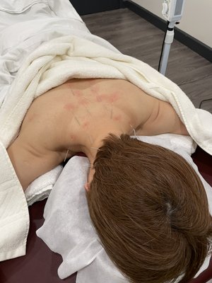 Japanese acupuncture use very thin like your hair needles!!