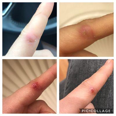 Week 2, 3, 4, and the day after I personally removed the "splinter" left in the cut. (Finally healing)