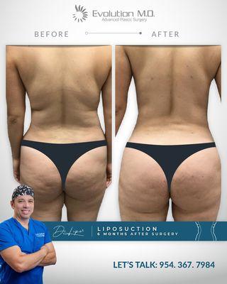 Before and after lipo