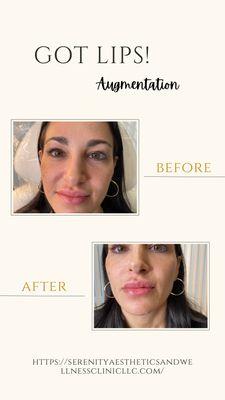 Wonderful Lip Augmentation on a beautiful young lady! Smooches !