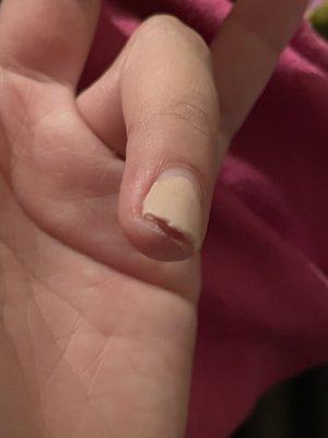 3rd Broken nail