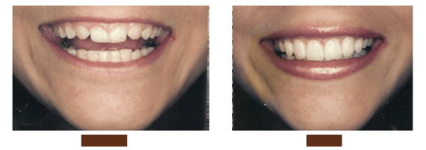 porcelain veneers