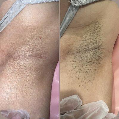 Underarm wax; would you rather wax 12 times a year or shave 2-3 times a week?