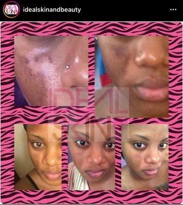 Idealskinandbeauty gives GUARANTEED results in as little as 3 days - a week 

This removes chemical peel burns and more