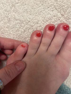 Non existent pinky toe nail