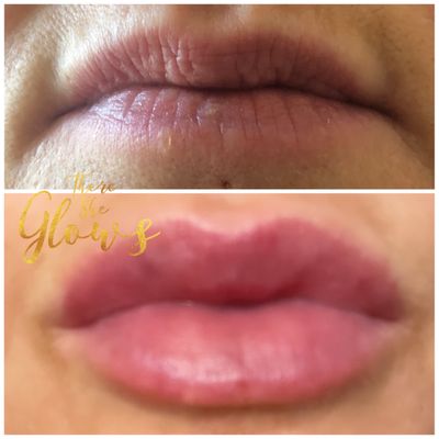 Hyaluron Pen lip fillers