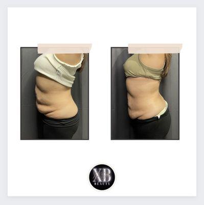 Are you looking for a way to reduce stubborn fat without surgery? Look no further!