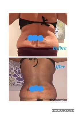 Body Contouring