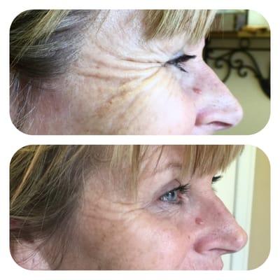 Before and after using injectables to soften crow's feet lines around the eyes. By Anne Swann, RN, Advanced Certified Injector.