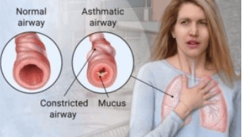 Diagnosing asthma and treatment of asthma