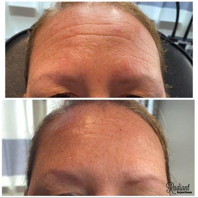 Botox/Dysport treatment