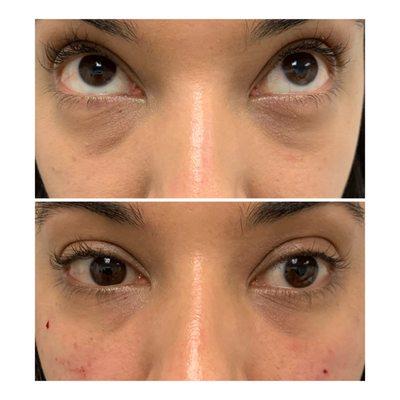 Under Eye Refresh with Tear Trough filler