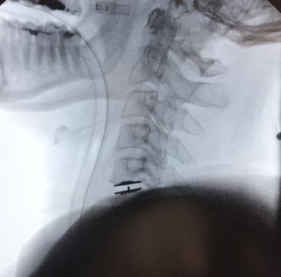 Intra-operative xray of an artificial cervical disc implanted at the C5-6 level as an outpatient