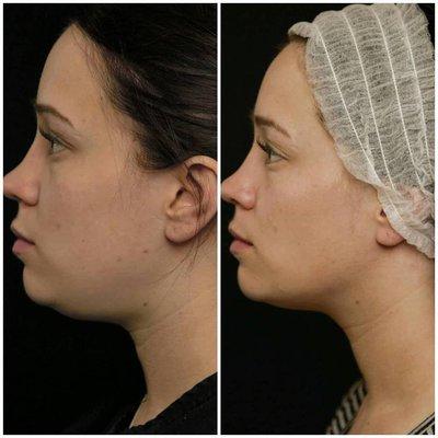 Kybella treatment for double chin. Two treatments.