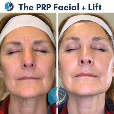 PRP Facial + Lift Amazing for reducing scarring, wrinkles, and improving complexion.