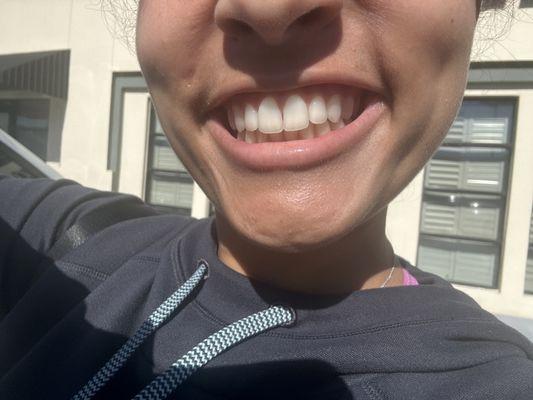 My daughters chompers look amazing!