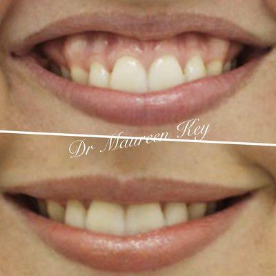 "Gummy smile" treated with just 4 units of Botox. If you are unhappy with your smile showing a lot of your gums- give us a call.