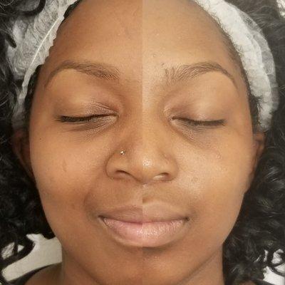 Before and after 1 carbon facial treatment