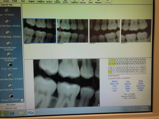 Digital X-rays