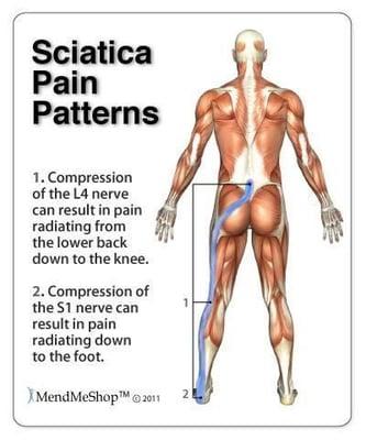 You've got sciatica, we've got relief!