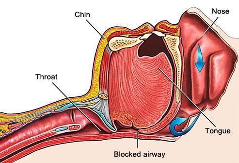 Sleep Apnea and snoring occurs when your soft palate partially or completely blocks the airway.