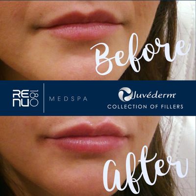 #Juvederm at Re:nu 180 Medspa