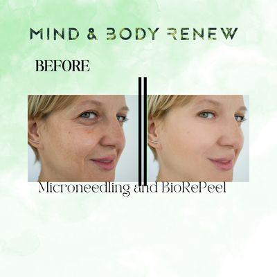 Microneedling and peels