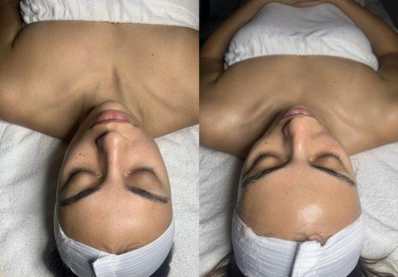 Before and after microdermabrasion facial