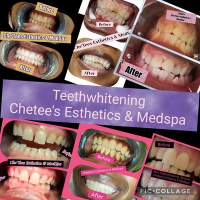 Teethwhitening