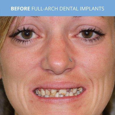 BEFORE Guided Full-Arch Dental Implants