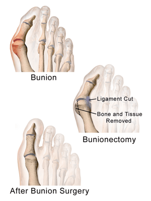 Bunion Treatment