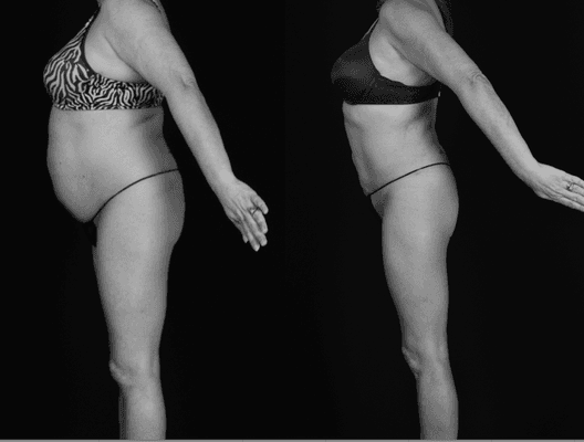 SAFELipo® results.  Visit parkcitiescosmeticsurgery.com to learn more about advanced body contouring.